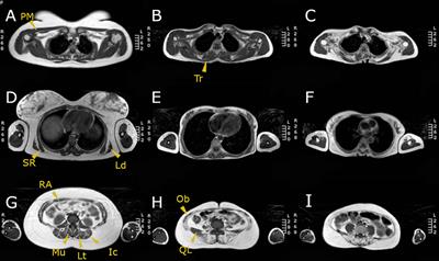 Correlation Between Respiratory Accessory Muscles and Diaphragm Pillars MRI and Pulmonary Function Test in Late-Onset Pompe Disease Patients